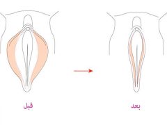 کدام جراحی زیبایی اعتماد بنفس بانوان را در رابطه زناشویی افزایش میدهد؟