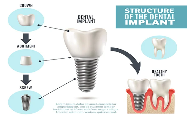 فیکسچر ایمپلنت چیست و چه کاربردی دارد؟ فیکسچر ایمپلنت چیست و چه کاربردی دارد؟