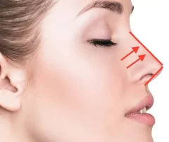 لیفت بینی استخوانی
