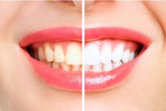 تفاوت لمینت دندان با بلیچینگ
