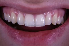 تفاوت لمینت سرامیکی با لمینت کامپوزیتی