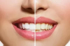 ترمیم کامپوزیت دندان