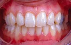 لمینت دندان قبل و بعد