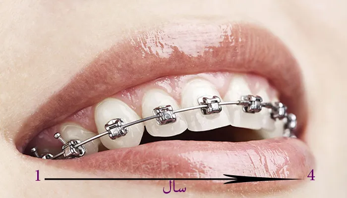 لبخندی زیبا، اما کدام روش برای شما مناسب است؟ لمینت دندان یا ارتودنسی؟ معایب ارتودنسی