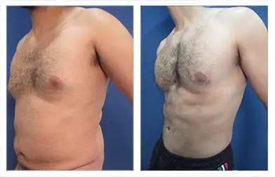 نکات هایدژنیک قبل و بعد از جراحی شکم