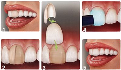 انواع لمینت دندان را بشناسید نصب نادرست لمینت دندان