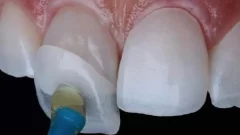 عوارض نصب نادرست لمینت دندان