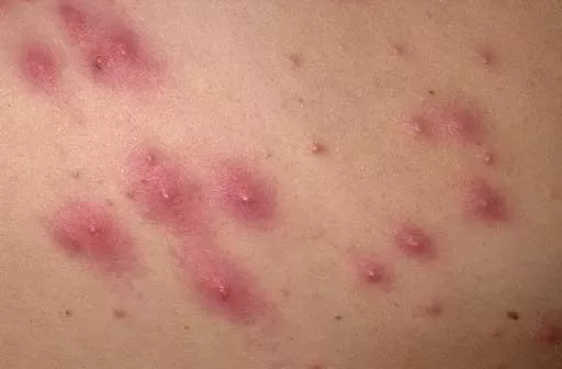 جوش مقعدی