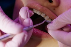 عوارض و مضرات جوش شیرین برای دندان و سفيد كردن دندان