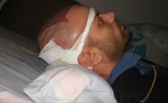 چرا بعد از کاشت مو نباید به پهلو خوابید ؟