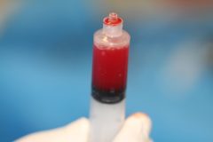 L-PRF در ایمپلنت