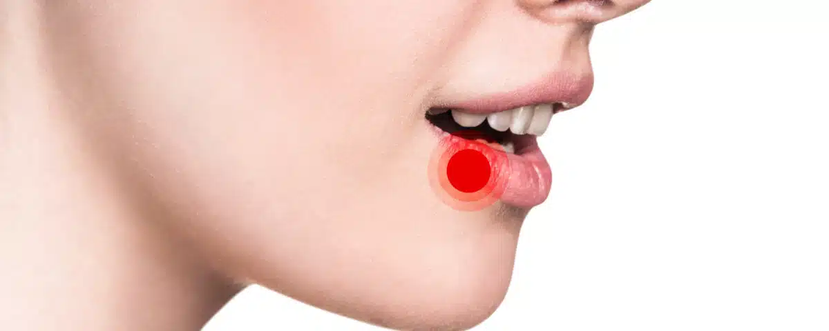 آفت دهان