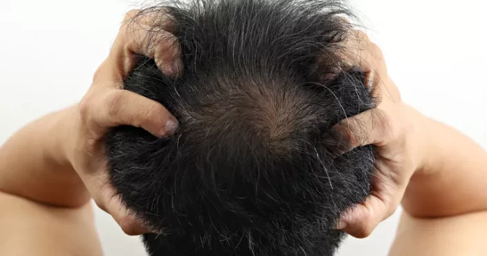 برای ریزش موی شدید چه باید کرد ؟