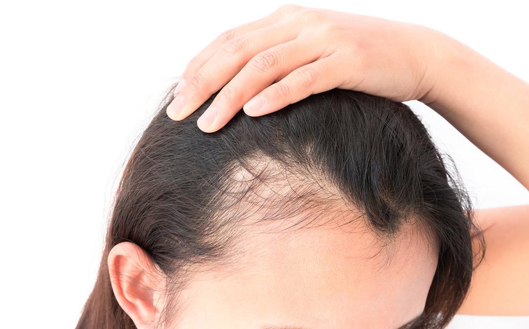 راهکارهای مقابله با ریزش موی شدید