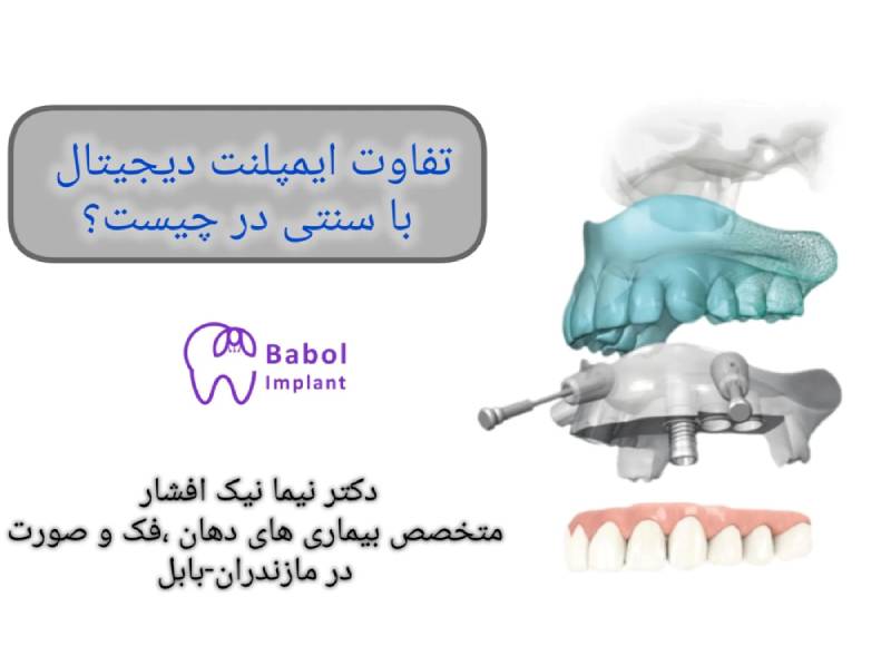 تفاوت ایمپلنت دیجیتال و ایمپلنت معمولی در چیست؟ تفاوت ایمپلنت دیجیتال و سنتی