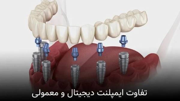 تفاوت ایمپلنت دیجیتال و ایمپلنت معمولی در چیست؟ تفاوت ایمپلنت دیجیتال و ایمپلنت معمولی در چیست؟