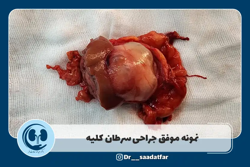 معرفی بهترین دکتر اورولوژی اصفهان نمونه-موفق-جراحی-سرطان-کلیه